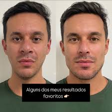 HARMONIZAÇÃO FACIAL| ESTÉTICA DO FUTURO