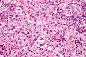 Other articles where benign tumour is discussed: Germ Cell Tumor Wikipedia