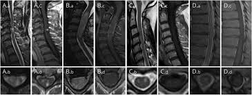 Partial transverse myelitis and partial myelitis are terms sometimes used to specify inflammation that only. Evaluation Of Idiopathic Transverse Myelitis Revealing Specific Myelopathy Diagnoses Neurology