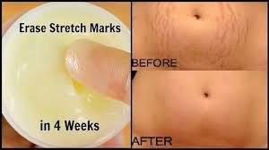 This Cream Will Erase All Stretch Marks From Your Skin Like Rubber Ingredients Aloe Vera Gel 1 Tbsp Lemon Ge Stretch Marks Beauty Care Aloe Vera Gel