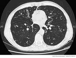 Lady Windermere Syndrome Does It Occur Only In Women Archivos De Bronconeumologia