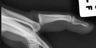 Image result for Volar PIP Dislocation