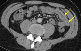 Image result for Neutropenic Colitis