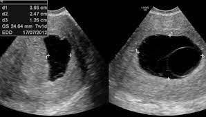 In an anembryonic pregnancy, however, the trophoblast attaches itself to the uterus, but the blastocyst never fully forms. Anembryonic Pregnancy Radiology Reference Article Radiopaedia Org