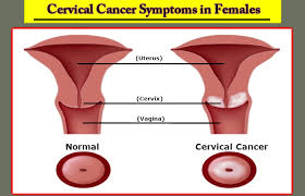 Hpv is a common virus that is passed from one person to another during sex. Detecting Cervical Cancer Symptoms In Females