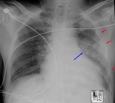 Image result for Pulmonary Contusion