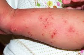 Image result for skin rash similar to scabies