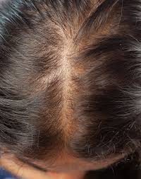 Image result for Alopecia
