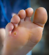 19 Home Remedies For Corns And Calluses Corn Treatment Home Remedies Alternative Health Care