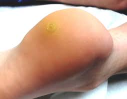 Viruses that cause warts are called human papillomavirus (hpv). The Most Problematic Warts Have No Sure Treatment Clinician Reviews