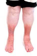 Image result for Lipodermatosclerosis