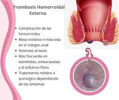 Es lo que se llaman hemorroides trombosadas. La Trombosis Dra Rosio Jimenez Coloproctologa