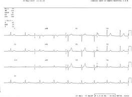 how to read an electrocardiogram ecg part one basic