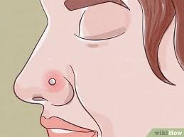 This will allow the infected area to clear up and heal on its own. 3 Ways To Treat An Infected Nose Piercing Wikihow