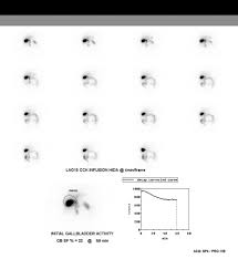 Cholescintigraphy Radiology Reference Article Radiopaedia Org