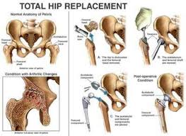 Total Hip Replacement Total Hip Replacement Hip Replacement Hip Replacement Surgery