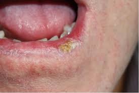 What does it mean when you have a tiny bump on your lip? Scc Cancer Skin Cancer Removal And Treatment