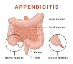 Image result for Appendicitis