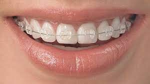Tratamento Dente Torto E Girado Com Facetas E Laminas Aparelho Luis Gustavo Leite Dentista Especialista Em Protese Dentaria Em Porto Alegre