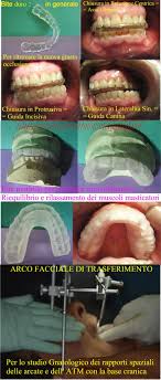 Non si sente dolore in quanto viene eseguito in anestesia locale. 16 Mesi Fa Ho Tolto Il Dente Del Giudizio Inferiore Sinistro