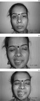 Customised gold weight eyelid implantation in paralytic lagophthalmos