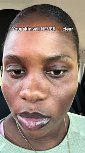 My skin was bad bad it looked like i had skinburn☹️ I'm so pround of c...