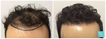 22 yo female underwent hairline lowering/forehead reduction surgery that was able to lower her hairline by 1 1/4 inches. Questions To Ask Hair Transplant Surgeon Before Fue Hair Transplant Procedure