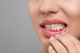 Image result for Gingivitis