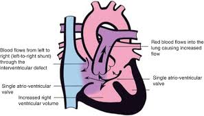 Image result for Endocardial Cushion Defect