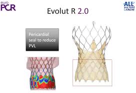 Corevalve Sizing