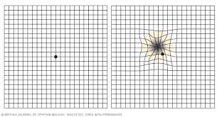 Wet Macular Degeneration Diagnosis And Treatment Mayo Clinic