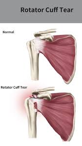 Image result for Rotator Cuff Rupture