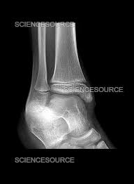 Image result for Ankle XRay
