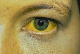 Image result for hepatitis b