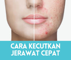 Tak heran diluar sana banyak beredar obat kimia yang nyasar kepada penderita dengan iming iming dapat dengan cepat. 5 Cara Nak Kecutkan Jerawat Dalam Masa Singkat 2021 Sihat Me