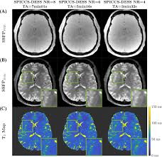 Rapid whole brain 3D T2 mapping respiratory‐resolved Double‐Echo Steady  State (DESS) sequence with improved repeatability - Kadalie - 2024 -  Magnetic Resonance in Medicine - Wiley Online Library