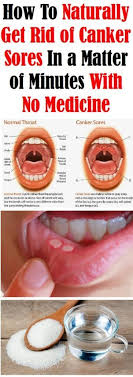 How To Naturally Get Rid Of Canker Sores In Minutes With No Medicine Your Health Here Canker Sore Cankers Mouth Ulcers
