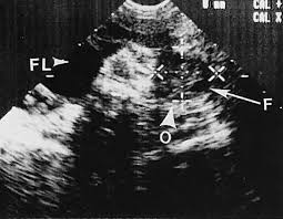 Ultrasound in the quantification of female pelvic organ prolapse. Diagnostic Ultrasonography In Gynecology Glowm