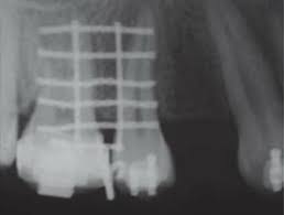 Tray transferred to the patient