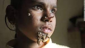 'tree man syndrome' is a rare, autosomal recessive genetic disorder, which affects deep skin tissues. Diagnosed First Female Case Of Tree Man Syndrome Clinical And Molecular Dx