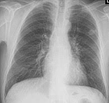 Rontgen Thorax Wikipedia