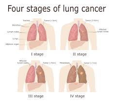 Coughing up lots of sputum, which may be bloody. Lung Cancer Symptoms Risk Factors Diagnosis And Treatment Saint John S Cancer Institute