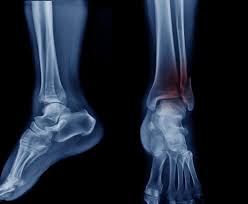 Image result for Ankle XRay