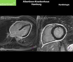 Eine herzbeutelentzündung wird als perikarditis bezeichnet. Perikarditis Doccheck Flexikon