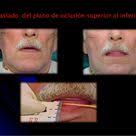 PASOS Prácticos #PrótesisTotales Parte4 Prueba  dientes/Ajustes/PrótesisTerminada #DentaduraCompleta