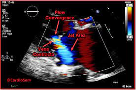 Quick review of color doppler of av fistula prof.dr. 3 Essential Color Doppler Measurements For Mitral Regurgitation