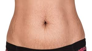 Laser therapy, needling, and microdermabrasion are three clinical treatments for stretch marks. 6 Ways To Get Rid Of White Stretch Marks