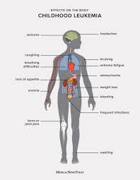 This weakness may be mild or. 11 Symptoms Of Leukemia In Children