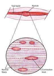 They are associated with palpable nodules in taut bands of muscle fibers. Trigger Points Symptom Or Cause Ripple Or Splash By Aidan Mccullen The Thursday Thought Medium