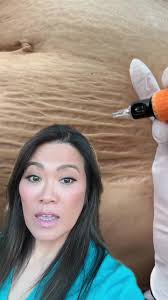 #duet with @boleynstudio #stretchmark i think tattoos can be great to  camouflage some scars that are embarrassing & noticeable because of the  color difference, but not all scars can be minimized in ...